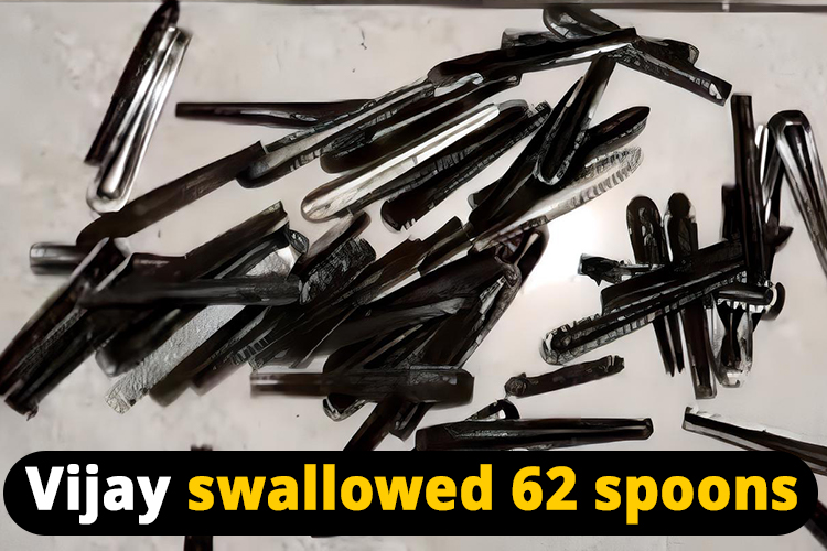 Doctor discovered 62 steel spoons from the stomach of a young man who swallowed them in drug de-addiction centre