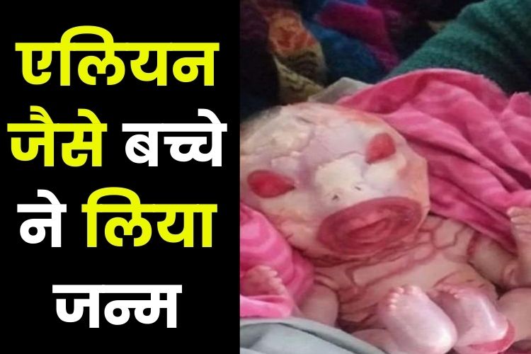 रतलाम में एलियन जैसे बच्चे ने लिया जन्म, शरीर पर नहीं हुआ चमड़ी का विकास