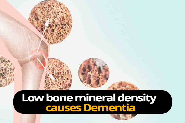 Low bone mineral density increases the risk of dementia among patients especially in males