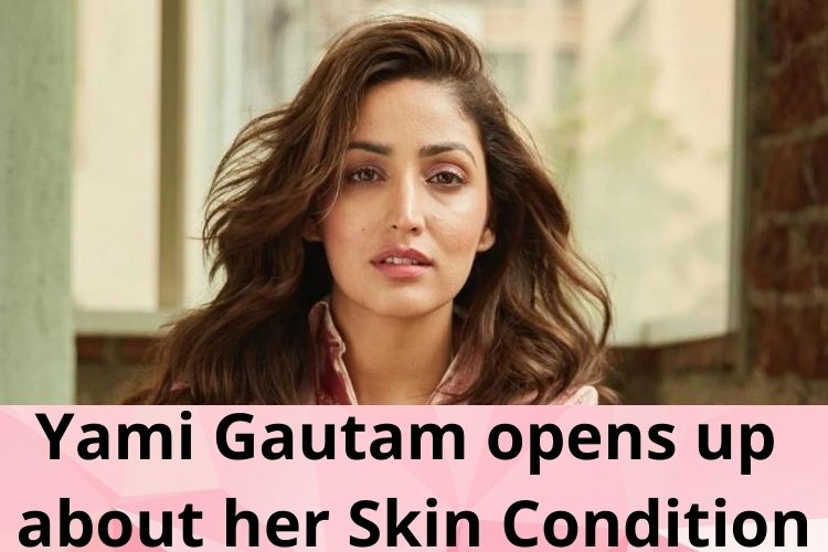 Yami Gautam opens up about her Skin Condition, Says 'Took Years to Accept it' 