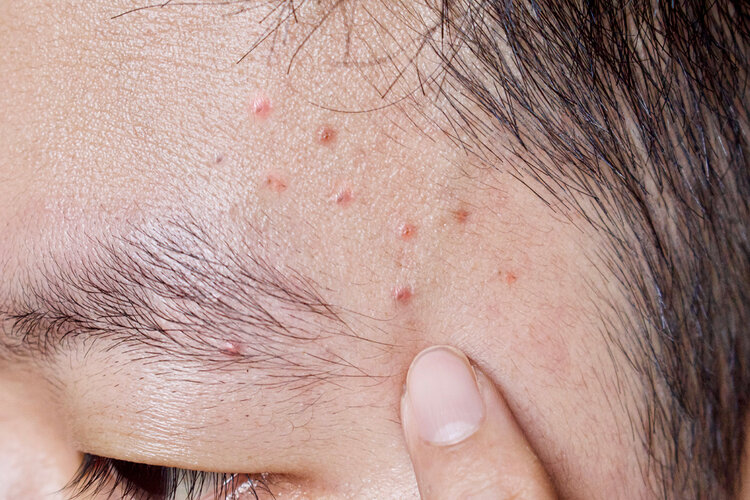 Trying to get rid of Acne? Read the simple hacks 