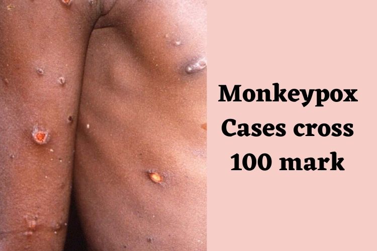 Monkeypox Cases Soaring High in Europe, 'It's a Community Spread', Says WHO 