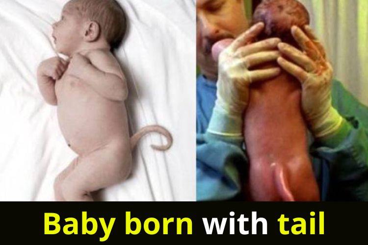 Mexican Baby girl born with an extremely rare tail